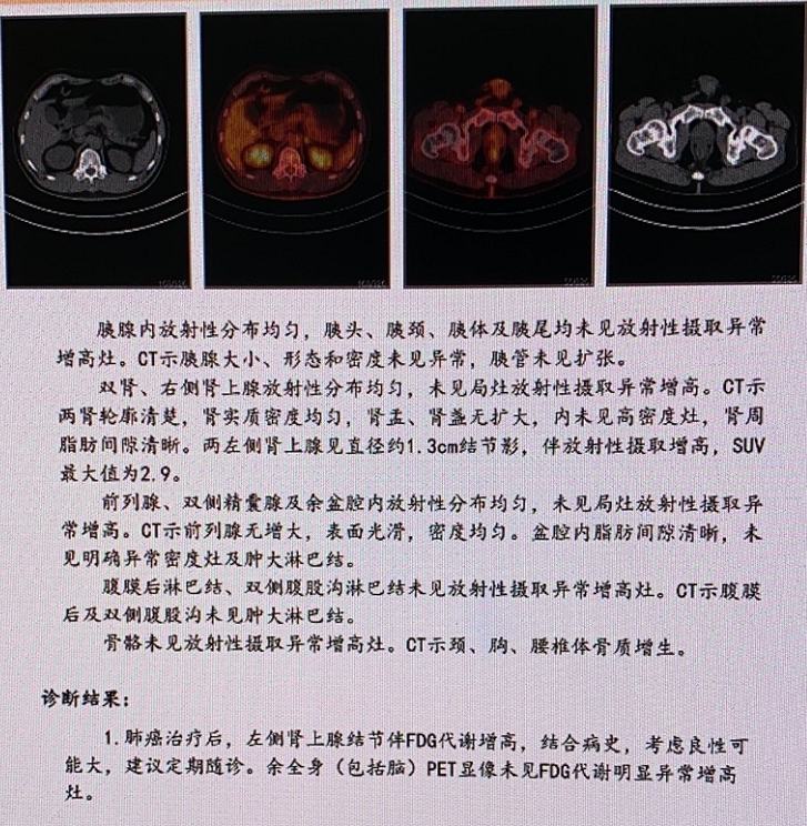 肺癌治疗后复查做PETCT检查
